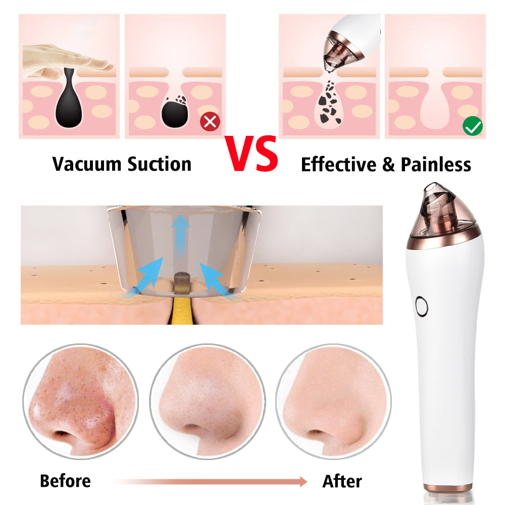 4-in-1 Body Gua Sha Cupping & Blackhead Remover Machine – Facial Pore Deep Cleansing