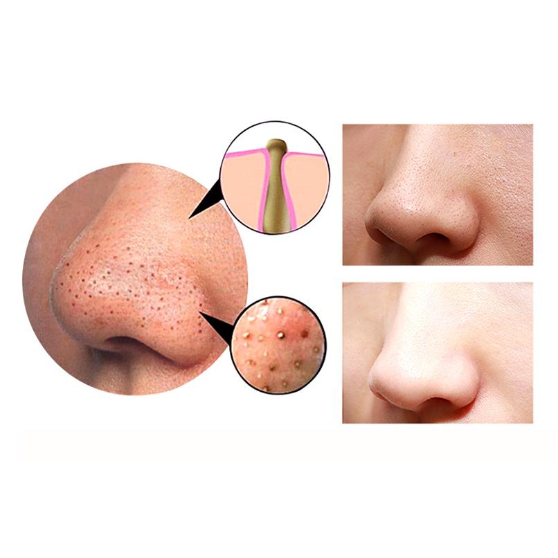 4-in-1 Body Gua Sha Cupping & Blackhead Remover Machine – Facial Pore Deep Cleansing